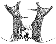 http://www.fascrs.org/global/images/migrated/fissure2.jpg