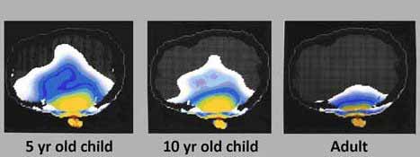 illustration showing an estimate of the absorption of radio frequency radiation into the brain based on age.