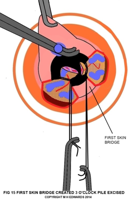 sms - haemorrhoidectomy