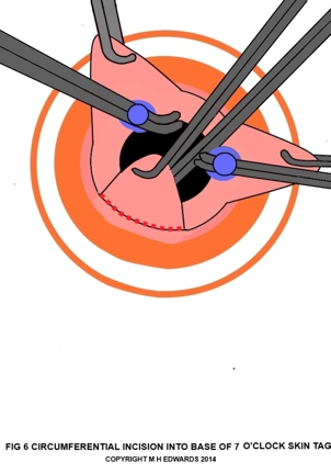 sms - haemorrhoidectomy