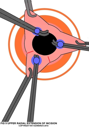 sms - haemorrhoidectomy