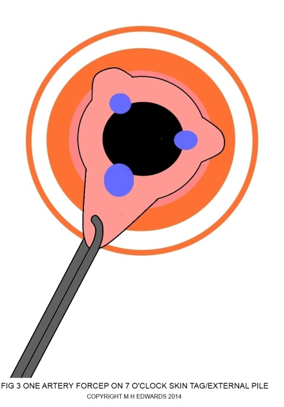 sms - haemorrhoidectomy