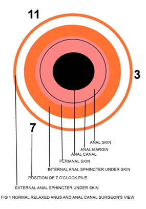 sms - haemorrhoidectomy