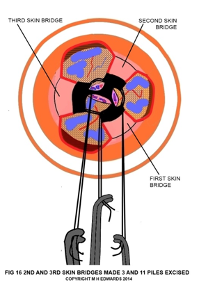 sms - haemorrhoidectomy