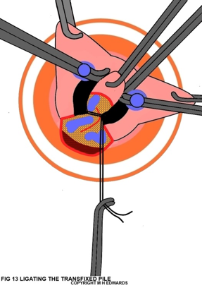 sms - haemorrhoidectomy