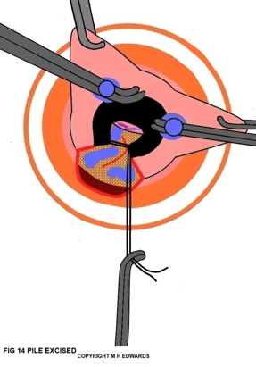 sms - haemorrhoidectomy