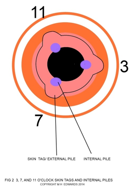 sms - haemorrhoidectomy