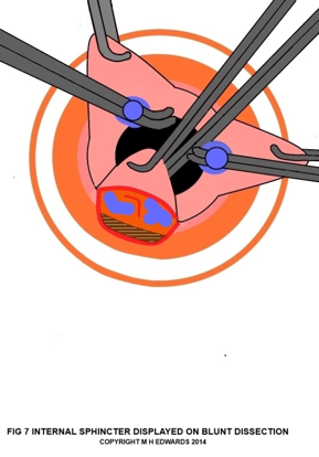 sms - haemorrhoidectomy