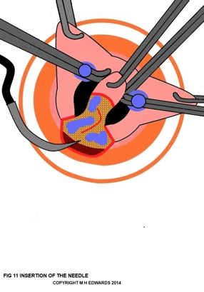 sms - haemorrhoidectomy