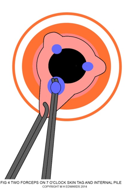 sms - haemorrhoidectomy