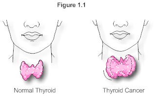 thryoid cancer.jpg