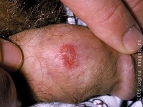 picture of psoriasis on the anogenital region in a male. this image displays a red, scaly, slightly elevated lesion on the penis. 