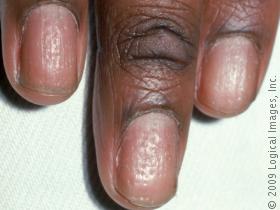 picture of psoriasis on the fingernail in a male. numerous tiny nail pits are common in people with psoriasis.