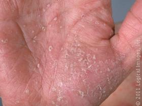 picture of psoriasis on the palm in a male. this image displays minimal scale with subtle redness due to psoriasis. 