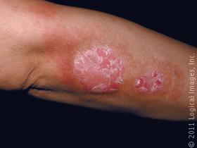 psoriasis can have large, scaling, slightly elevated lesions. these lesions are usually found near or at the elbow as well as the forearm, knees, legs, scalp, buttocks, and genital areas. 