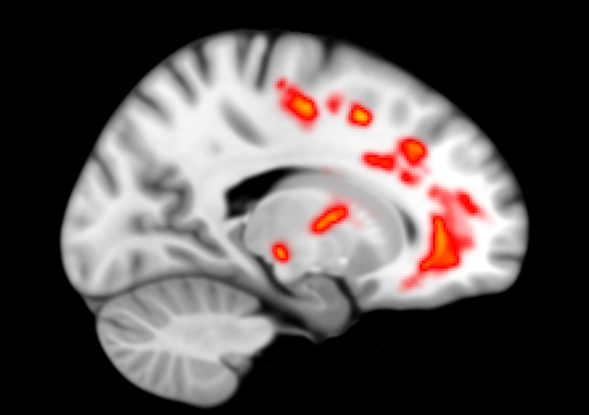image showing areas of damaged wiring in the brain