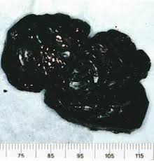 image result for black tar heroin