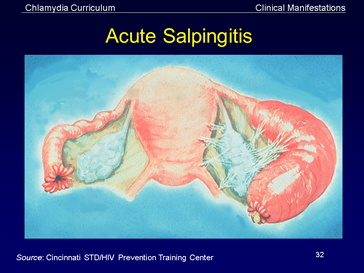 acute salpingitis 