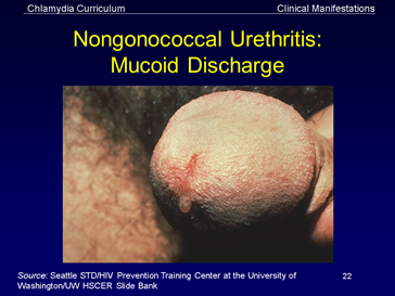 nongonococcal urethritis: mucoid discharge