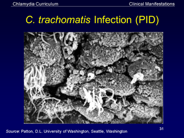 c. trachomatis infection (pid)