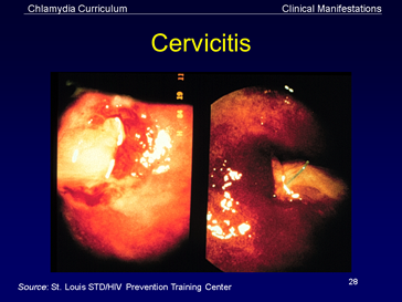 cervicitis