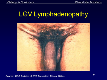 lgv lymphadenopathy