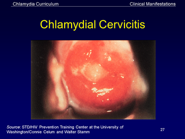 chlamydial cervicitis