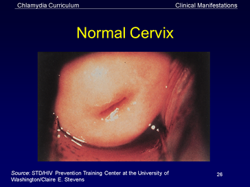 normal cervix 