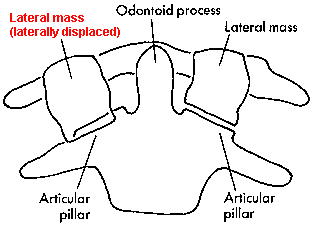 d:\viktoro\neuroscience\trs. spinal trauma\00. pictures\jefferson fracture (schema) 2.gif