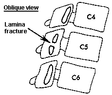 d:\viktoro\neuroscience\trs. spinal trauma\00. pictures\lamina fracture (schema).gif