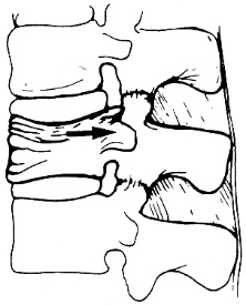 d:\viktoro\neuroscience\trs. spinal trauma\00. pictures\burst fracture (sheme).jpg