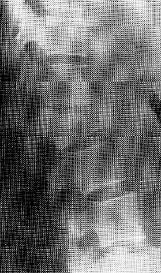 d:\viktoro\neuroscience\trs. spinal trauma\00. pictures\burst fracture (ro) 2.jpg