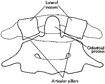 d:\viktoro\neuroscience\trs. spinal trauma\00. pictures\posterior neural arch fracture (schema) 2.gif