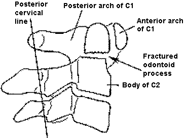 d:\viktoro\neuroscience\trs. spinal trauma\00. pictures\odontoid fracture with anterior dislocation.gif