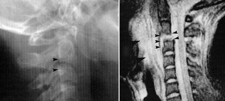 d:\viktoro\neuroscience\trs. spinal trauma\00. pictures\subluxation (x-ray, mri).jpg