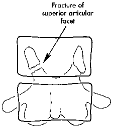 d:\viktoro\neuroscience\trs. spinal trauma\00. pictures\rotation fracture-dislocation of lumbar spine (scheme) 1.gif