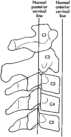 d:\viktoro\neuroscience\trs. spinal trauma\00. pictures\subluxation (schema) 1.gif