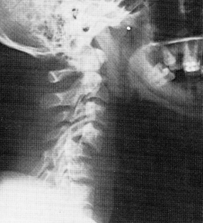 d:\viktoro\neuroscience\trs. spinal trauma\00. pictures\bilateral facet dislocation (ro).jpg