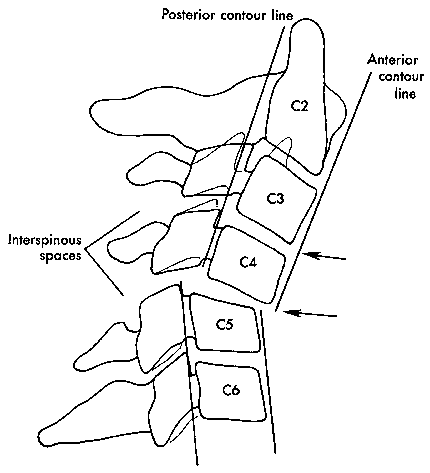 d:\viktoro\neuroscience\trs. spinal trauma\00. pictures\subluxation (schema) 2.gif