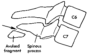 d:\viktoro\neuroscience\trs. spinal trauma\00. pictures\clay\'s shoveler\'s fracture (schema) 2.gif