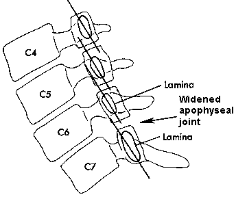 d:\viktoro\neuroscience\trs. spinal trauma\00. pictures\unilateral facet dislocation (schema) 3.gif