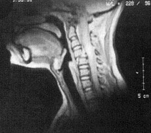 d:\viktoro\neuroscience\trs. spinal trauma\00. pictures\subluxation (mri).jpg