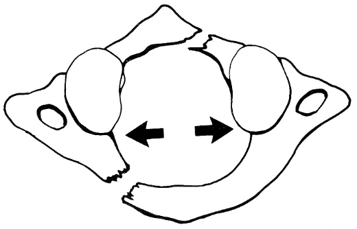 d:\viktoro\neuroscience\trs. spinal trauma\00. pictures\jefferson fracture (schema) 4.jpg