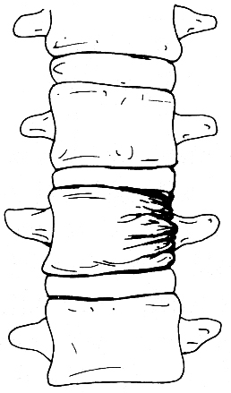 d:\viktoro\neuroscience\trs. spinal trauma\00. pictures\lateral wedge compression fracture (scheme).jpg