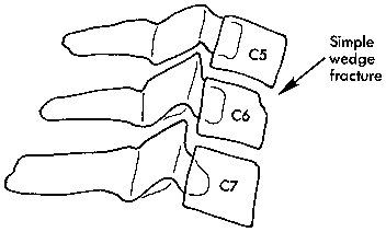 d:\viktoro\neuroscience\trs. spinal trauma\00. pictures\wedge fracture (schema).gif