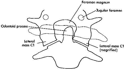 d:\viktoro\neuroscience\trs. spinal trauma\00. pictures\rotary atlantoaxial dislocation (schema).gif