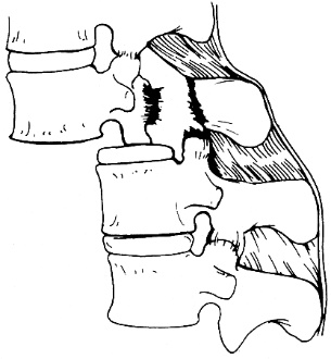 d:\viktoro\neuroscience\trs. spinal trauma\00. pictures\translational fracture-dislocation (scheme).jpg