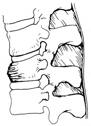 d:\viktoro\neuroscience\trs. spinal trauma\00. pictures\anterior wedge compression fracture (scheme).jpg