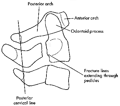 d:\viktoro\neuroscience\trs. spinal trauma\00. pictures\hangman\'s fracture (schema).gif