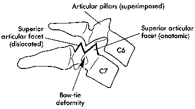 d:\viktoro\neuroscience\trs. spinal trauma\00. pictures\unilateral facet dislocation (schema) 2.gif